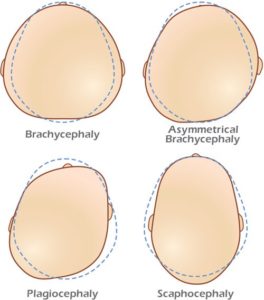 “Should I be concerned about my baby’s head shape?” – a frequent ...